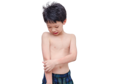 Child with a rash